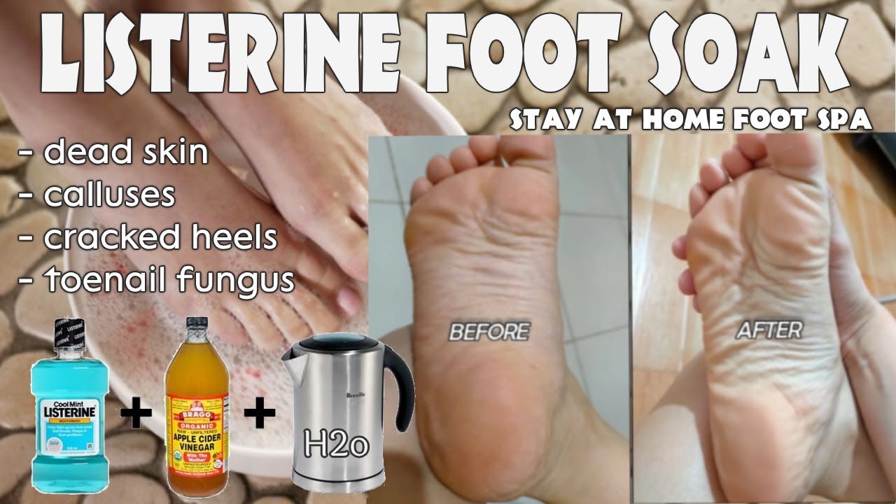 Listerine And Apple Cider Vinegar Foot Soak Demo Review Effective