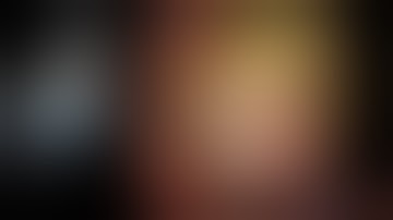 Case 8_ERCP and basket mechanical lithotripsy of complicated biliary stones