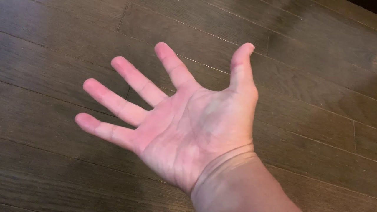 中手骨骨折したらオーバーラッピングフィンガーになった グーで指が重なる Youtube 中手骨骨折したらオーバーラッピングフィンガーになった グーで指が重なる Youtube