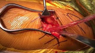 Bikini DAA THR with Mako Robotic - Ankylosed Hip