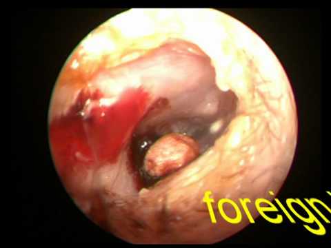 EAR FOREIGN BODY THERMACOOL IN A CHILDS EAR - YouTube