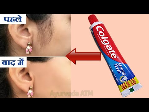in-2-minutes,-remove-unwanted-hair-permanently-||-no-shave-||-no-wax-||-ayurveda-atm-||