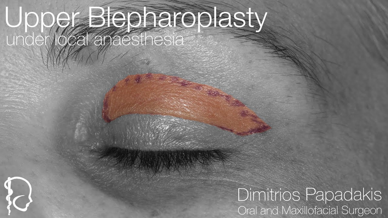 Cosmetic Upper Eyelid Surgery under Local Anaesthesia YouTube