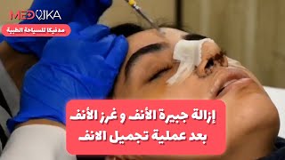 ازالة جبيرة الانف و ازالة غرز الانف بعد اسبوع من عملية تجميل الانف في ايران | مدفيكا