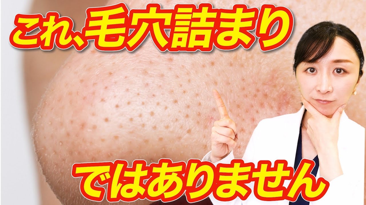 【毛穴】これ、毛穴詰まりではありません。正しいケア方法を解説！