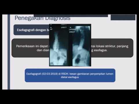 Video: Striktur Esofagus Benigna: Penyebab, Gejala & Diagnosis