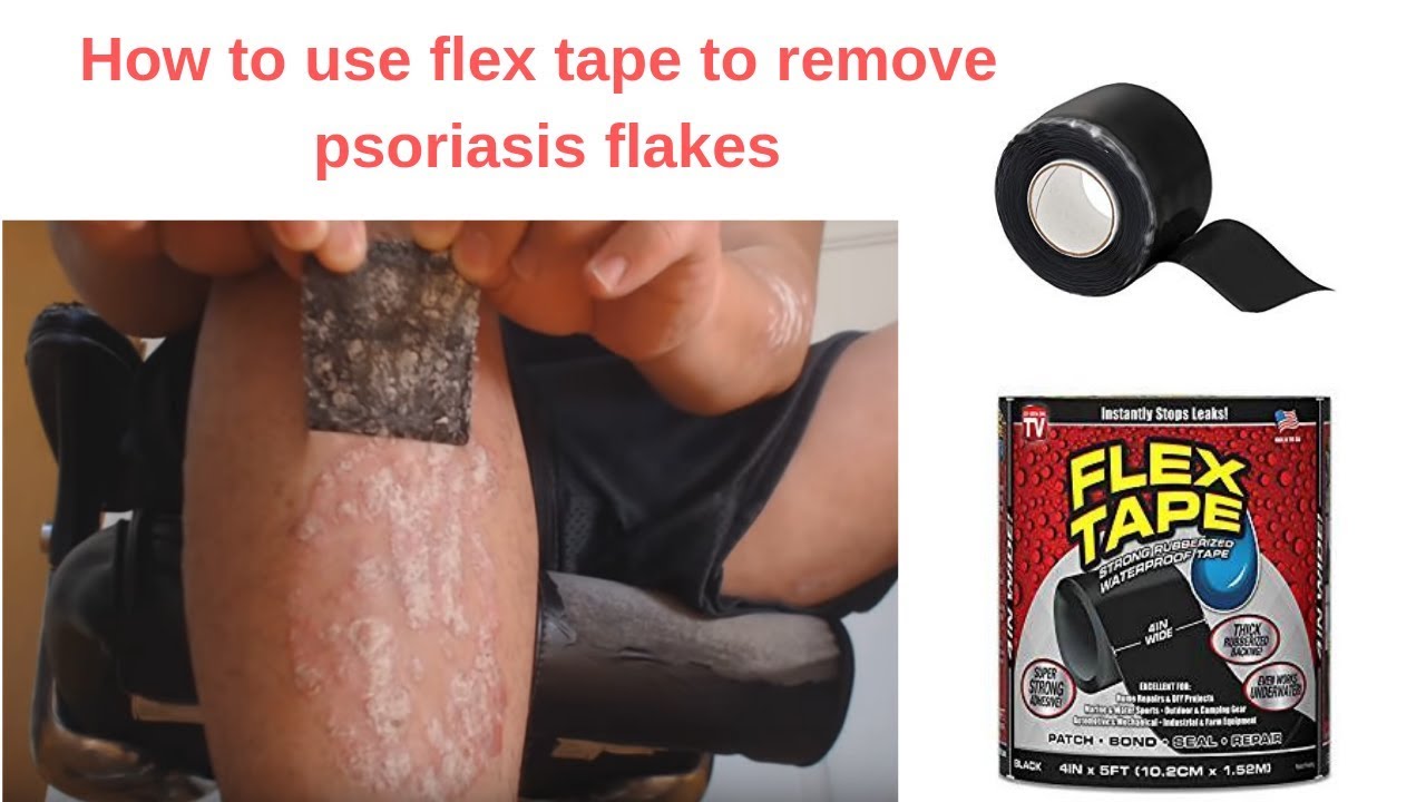 How to use flex tape to remove psoriasis flakes YouTube