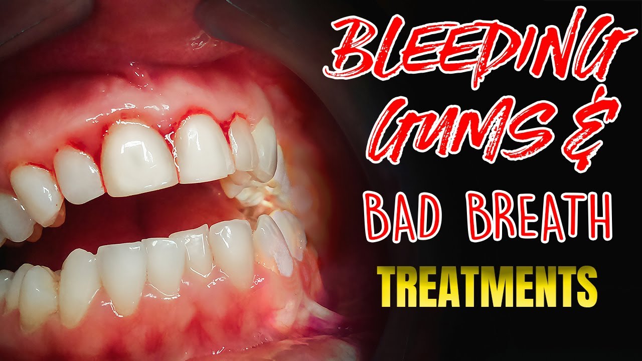 How To Treat Bleeding Gums and Bad Breath Home Remedy YouTube