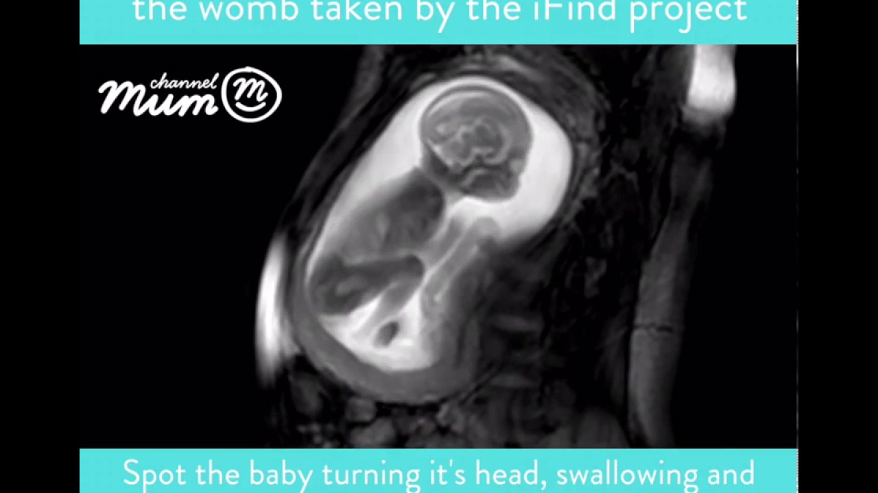 MRI of baby in the womb YouTube