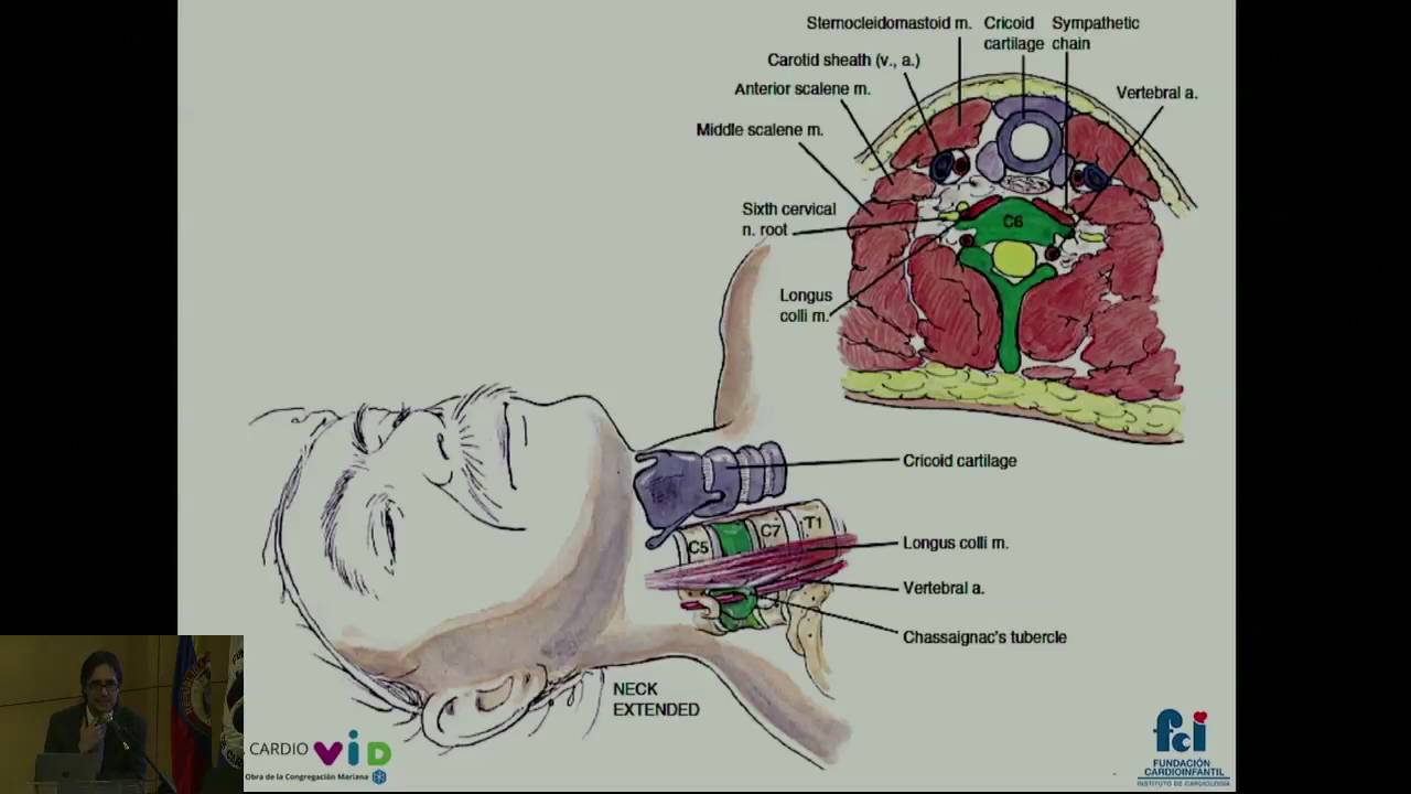 Bloqueo Percut neo De Ganglio Estrellado Con Bupivaca na Dr Juan bloqueo-percut-neo-de-ganglio-estrellado-con-bupivaca-na-dr-juan
