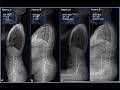 Working Effectively With Obese Patients in Radiography Fat Patients