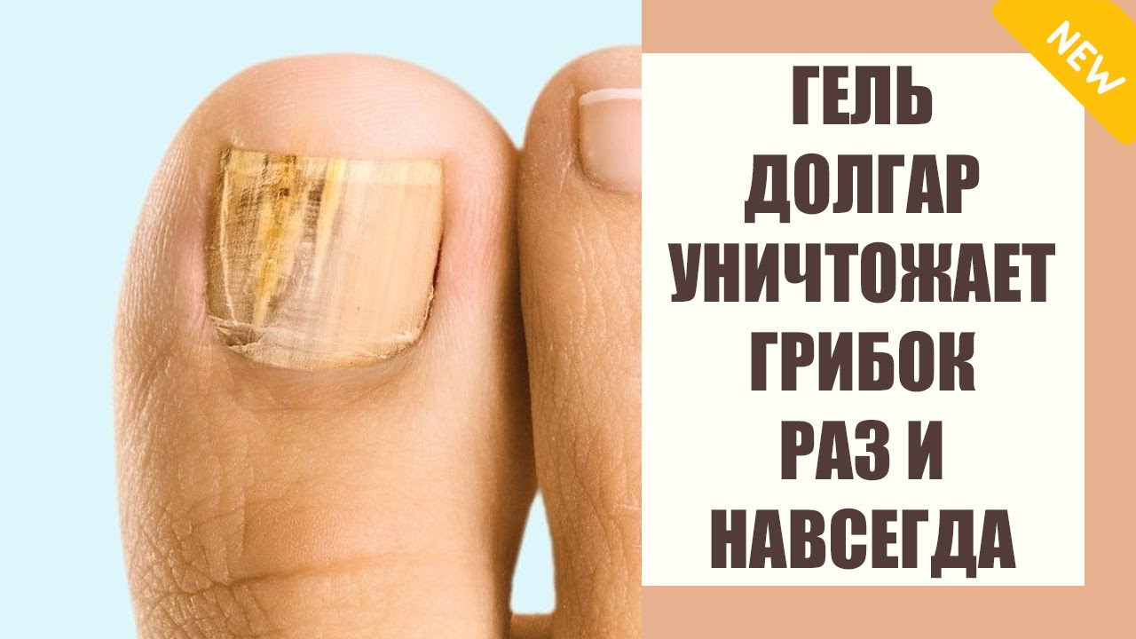 Грибок на ногах эффективное средство