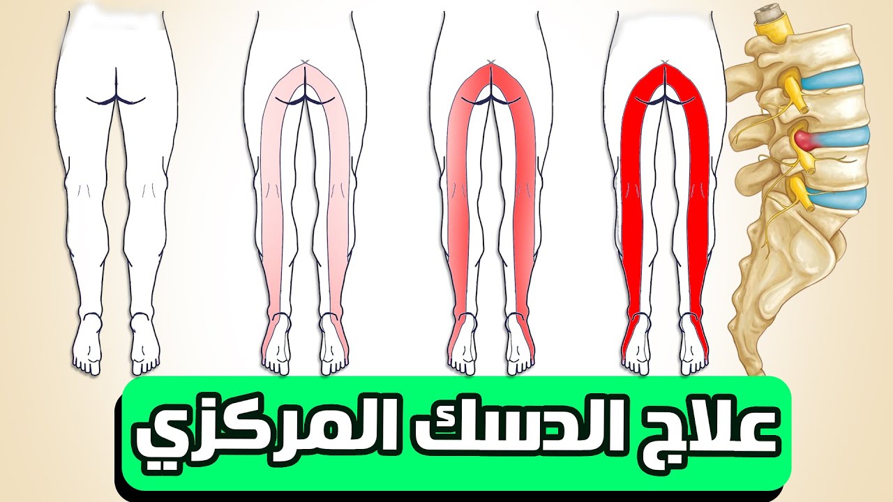 علاج الانزلاق او الدسك المركزي متلازمة ذيل الفرس  || ألم وخدر وتنميل يزيد مع المشي يختفي مع الجلوس