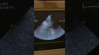 echocardiography kasiay hartay hain