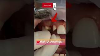 Dental Bridge تركيب كوبرى bridge fixed dentist shorts dental reduction