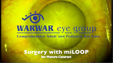 Warwar cataract surgery with miLOOP for mature cataract
