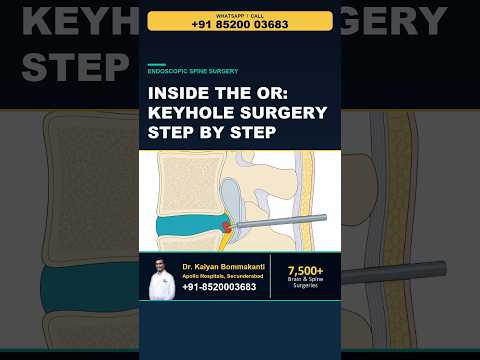 Inside the OR: Keyhole Surgery Step by Step - Best Monoportal Endoscopic Spine Surgery, Hyderabad