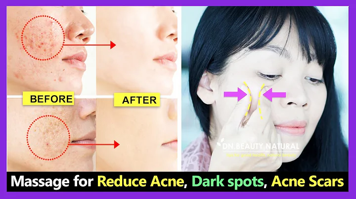 How to get rid of acne, reduce open pores, remove acne scars and dark spots with Face massage - DayDayNews