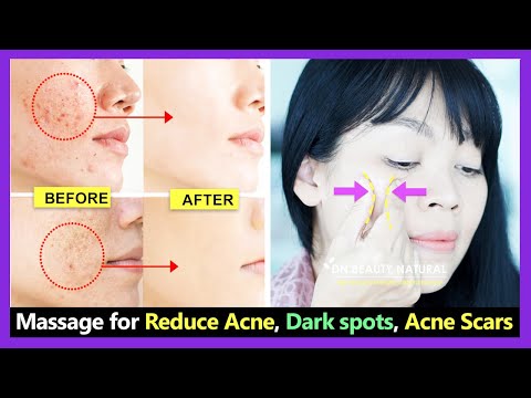 How to get rid of acne, reduce open pores, remove acne scars and dark spots with Face massage