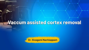 Videography Competition : Vaccum assisted cortex removal  - Dr. Sivagami Nachiappam
