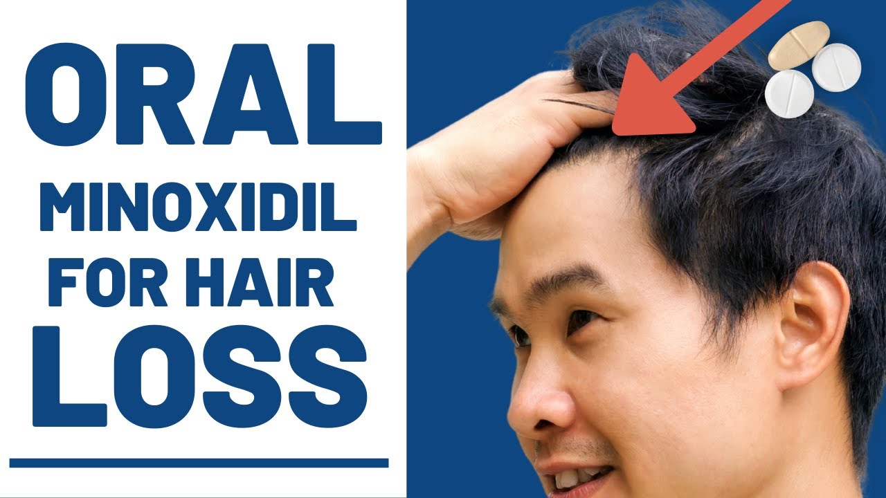 Oral Minoxidil For Hair Loss  My Skin of Color