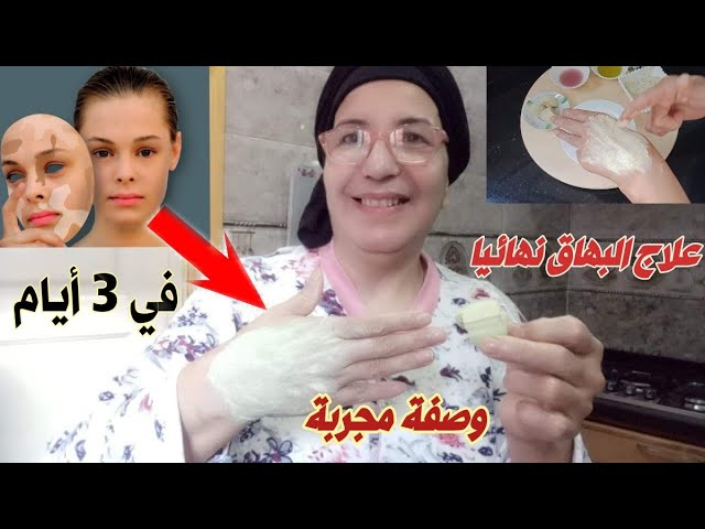 علاج البهاق في ساعة