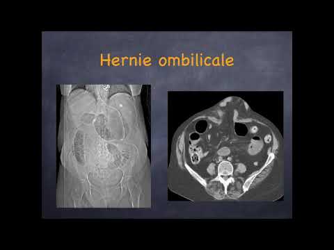 Vidéo: Récidive De Hernie Incisionnelle Après Réparation élective Ouverte: L'expertise En Matière De Chirurgie De La Paroi Abdominale Est Importante