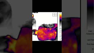Live Thermal Imaging During an Upper Cervical Adjustment | Real-Time Blood Flow Changes