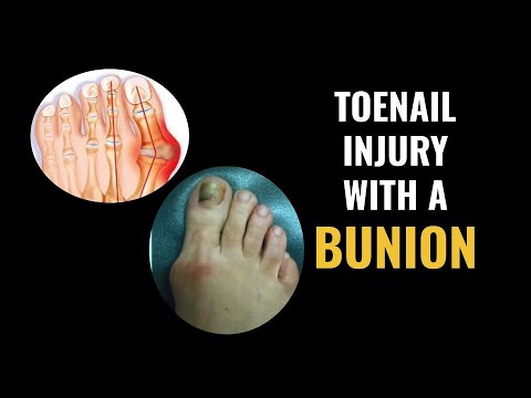 toenail-injury-with-bunion