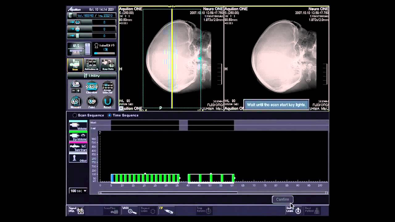 Aquilion ONE, Dynamic Volume Neuro CT - YouTube