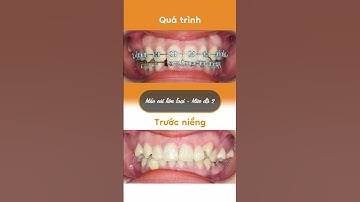 Hành trình LỘT XÁC nhờ niềng răng của Phương Thảo