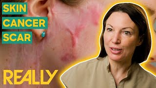 Dr. Emma Removes Facial Scar, Restoring Patient's Confidence | The Bad Skin Clinic