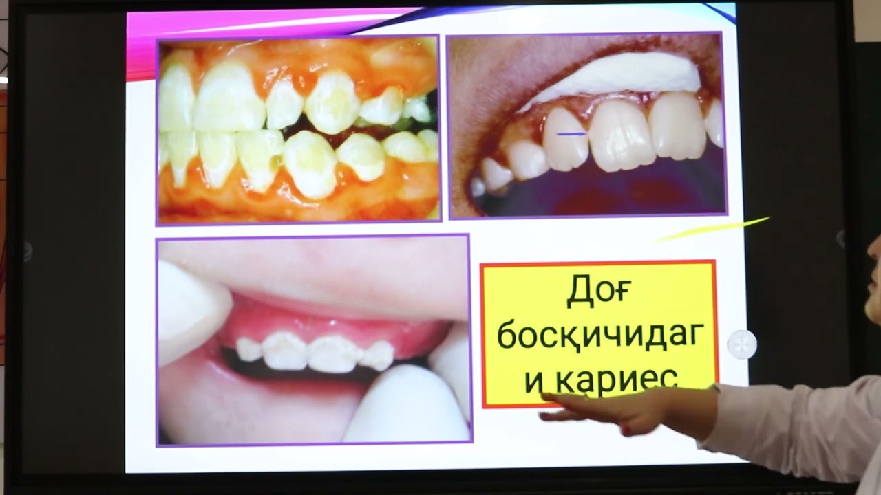 Karies haqida tushuncha. Karies kovaklarni tasnifi.