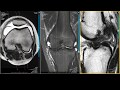 Wrisberg Rip, ACL Tear on MRI - Knee MRI