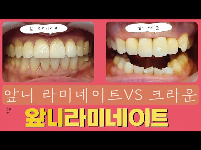 Gaoyang 치과 용 라미네이트와 올 세라믹의 차이점 11