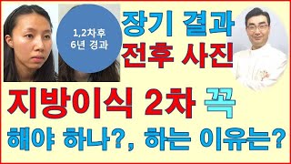 지방이식 2차 꼭 해야 하나?-지방이식 2차 필요성-얼굴지방이식-풀페이스 지방이식-페이스 리모델링