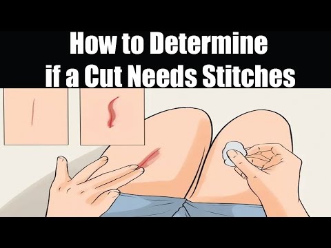 How to Determine if a Cut Needs Stitches | Remove Stitches