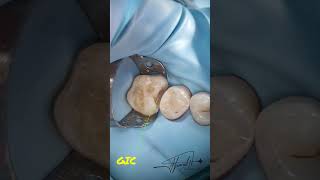 Direct pulp cap