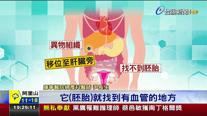 罕見子宮外孕21歲女胚胎著床在肝臟旁 - 天天要聞