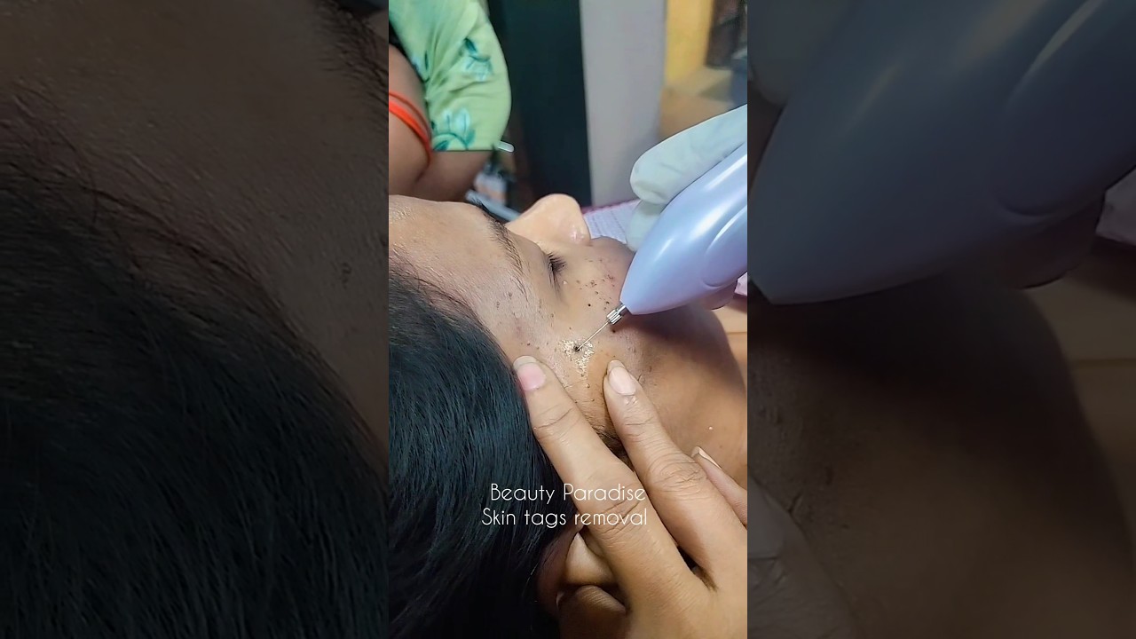 மரு நீக்குதல் Skin Tags removal treatment 