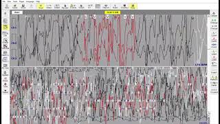 holetr ECG 24g HATHITHUON**   Philips Holter 1810 Series 2021 01 17 11 16 14- bs TRUNG ANH screenshot 1