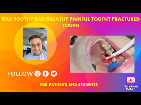 Video: Ar sulaužytas dantis pavojingas?