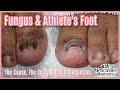 👣Big Toes Only - Toenail Fungus & Athlete's Foot Pedicure How To Transformation👣