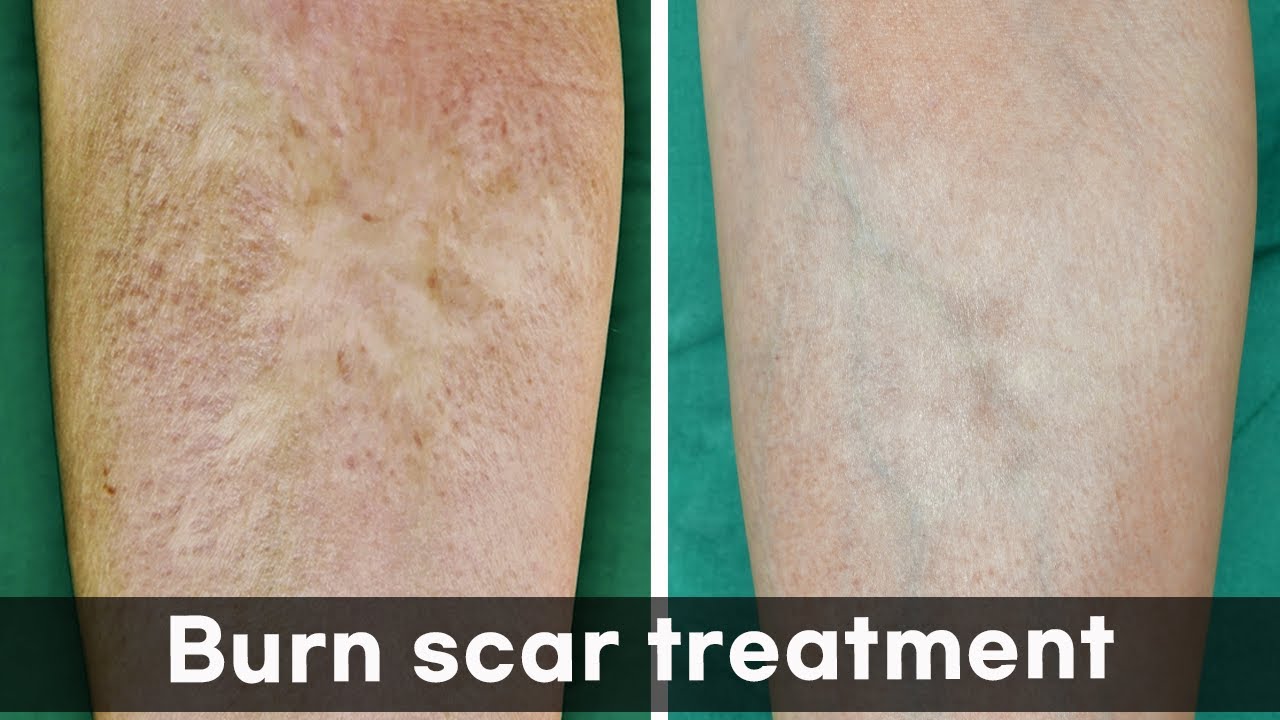 The Burn Scar Doctors Said Couldn’t Be Treated… Until Now