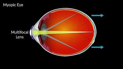 How Multifocal Contact Lenses Can Help Myopia (Audio Description)
