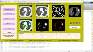 Lung Cancer Detection Using Image Processing Matlab Code Lung Cancer Prediction Using Matlab Code