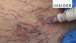 How Doctors Get Rid of Spider Veins