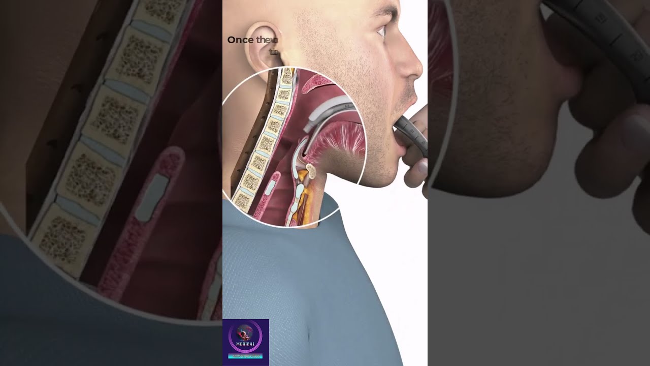 Endotracheal Intubation Education Shorts