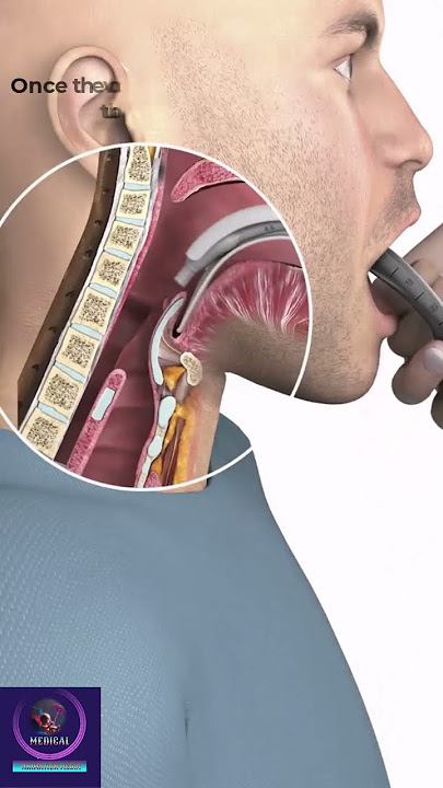 Endotracheal Intubation #education #shorts