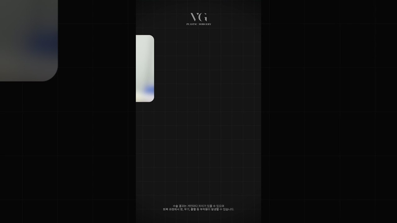 [Bệnh viện Thẩm mỹ Berry Good] 〰️Gồ ghề〰️ thành ➡️Mịn màng➡️ #Phẫu_thuật_mũi #Phẫu_thuật_mũi_nam #Nâng_mũi